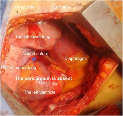 Case report: Delayed cardiac rupture with congenital absence of pericardium after blunt trauma